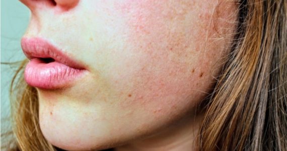 efectos del coronavirus en la piel